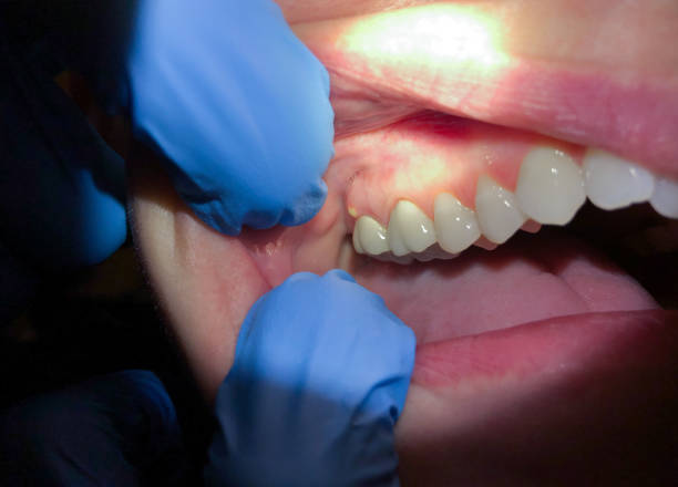 Best Emergency Gum Treatment in North Fond Du Lac, WI